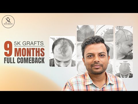 He Was Almost Bald… Now Look at His Hair 😳 | Hair Transplant in Nagpur | New Roots