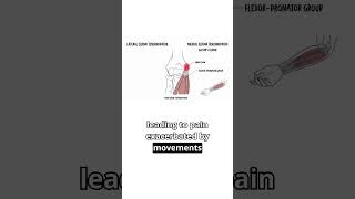 When a Swing Turns Into Pain #golferselbow  #elbowpain  #tendinopathy  #sportsinjury  #orthopedics