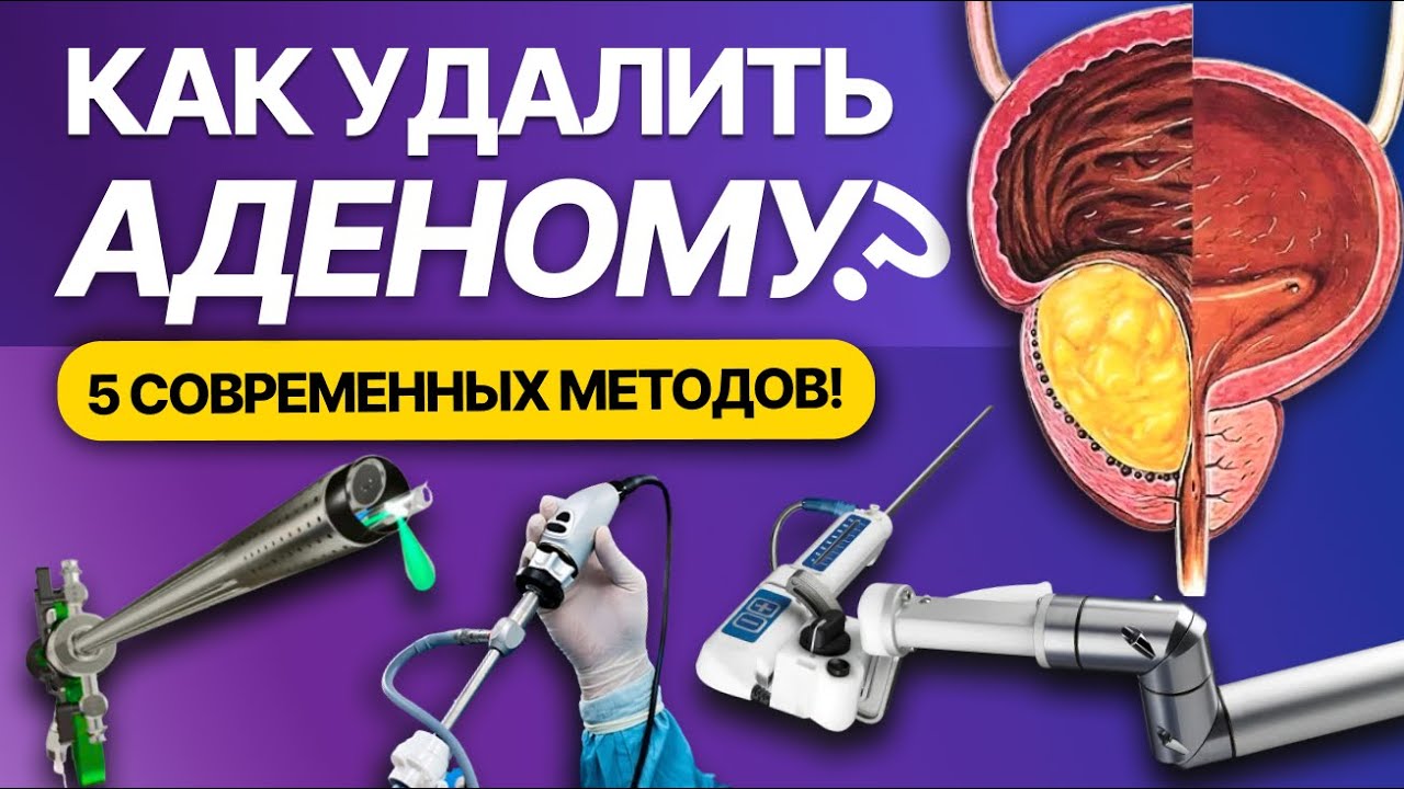 Большая аденома простаты. Пять эффективных способов удаления. Осложнения, преимущества и недостатки