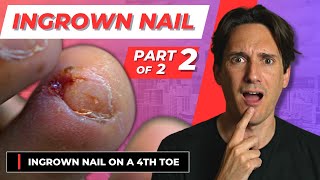 INGROWN TOENAIL of a 4th Toe part 2 of 2