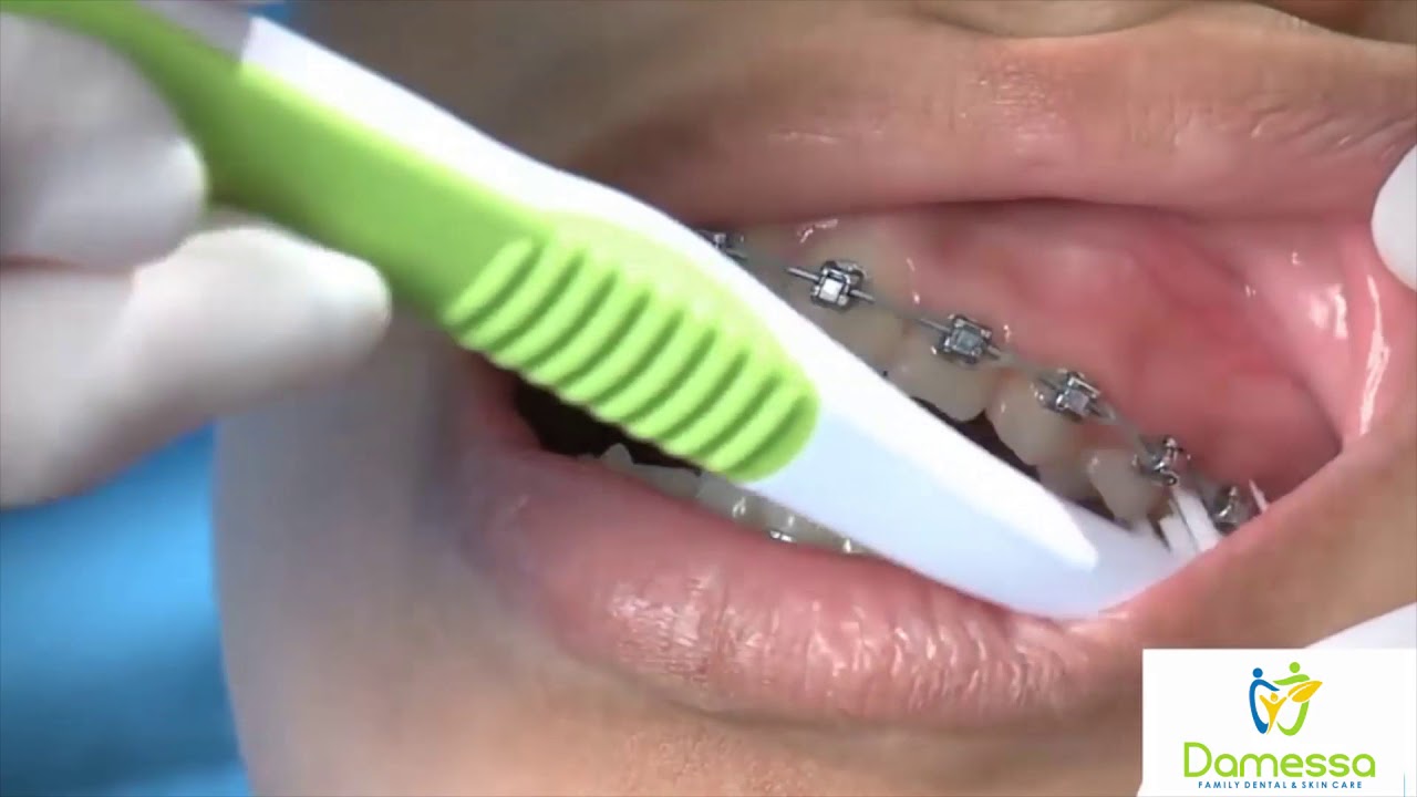 Tutorial Sikat Gigi Behel YouTube