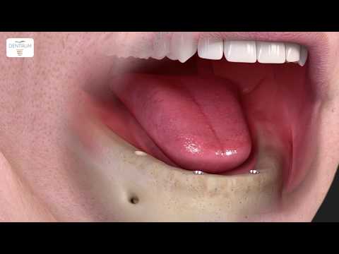 Wideo: Implantacja All-on-4 Przy Braku Zębów