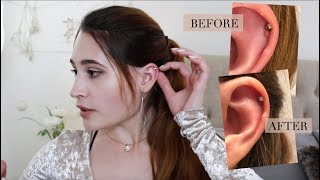 Famous How I Treated My Hypertrophic Scar on Helix Piercing (with photos) Net Worth