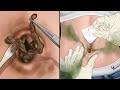 Asmr      remove huge navel stone animation  very satisfying by ybeauty