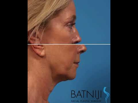 Lower facelift /