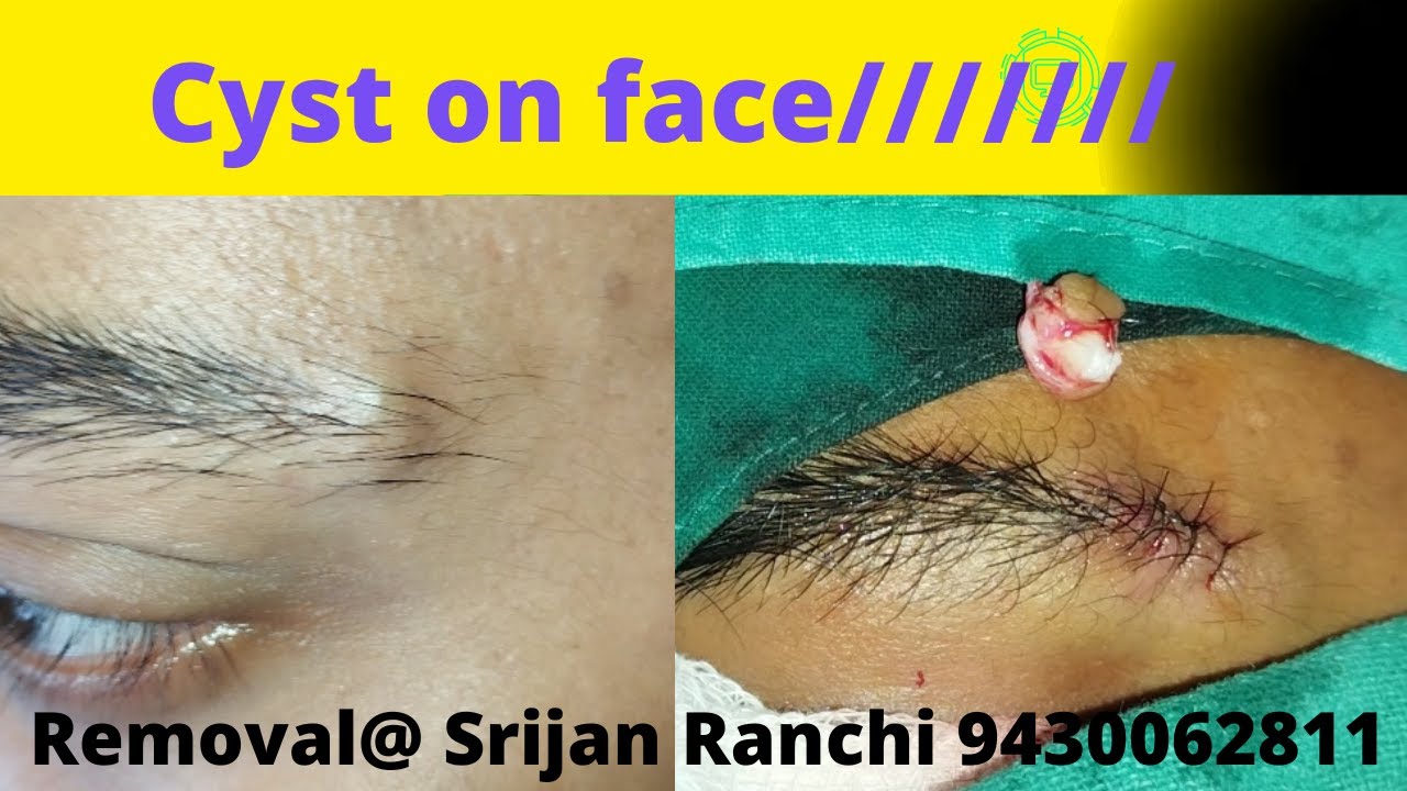 Sebaceous Cyst Removal Cyst Treatment In Ranchi Drpankaj Kumar