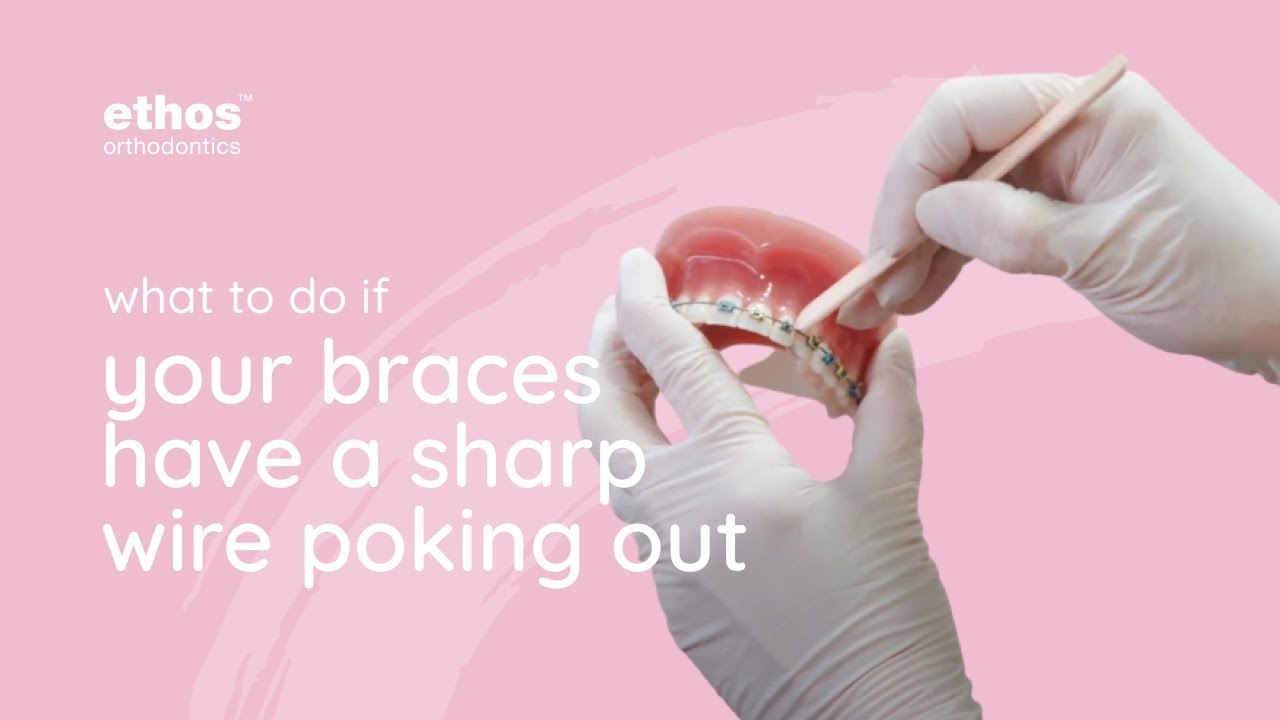 What To Do If You Have A Sharp Braces Wire - Ethos Orthodontics