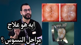 ايه هي مراحل التسوس وعلاجها؟ #د_عبدالسلام_محمد #التجمع_الخامس #المهندسين #Smile_Expertez #fpy