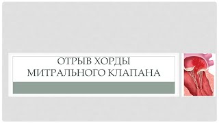 Отрыв хорды митрального клапана