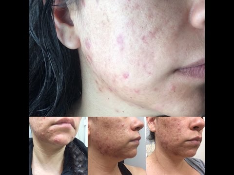 proactiv for cystic acne