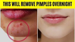 How to Remove Pimples Overnight | Acne Treatment