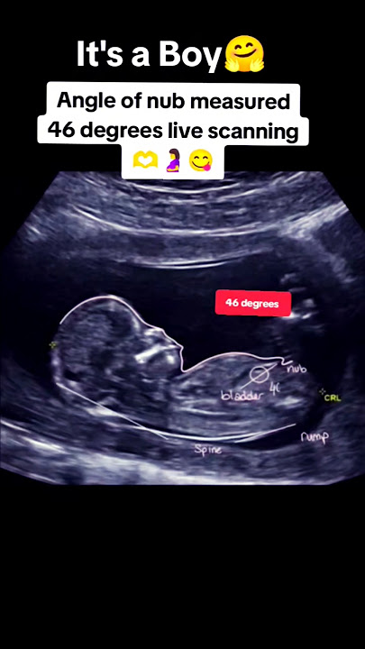 it's a boy🫶 angle of nub measured 46 degrees live scanning|#pregnancy #baby
