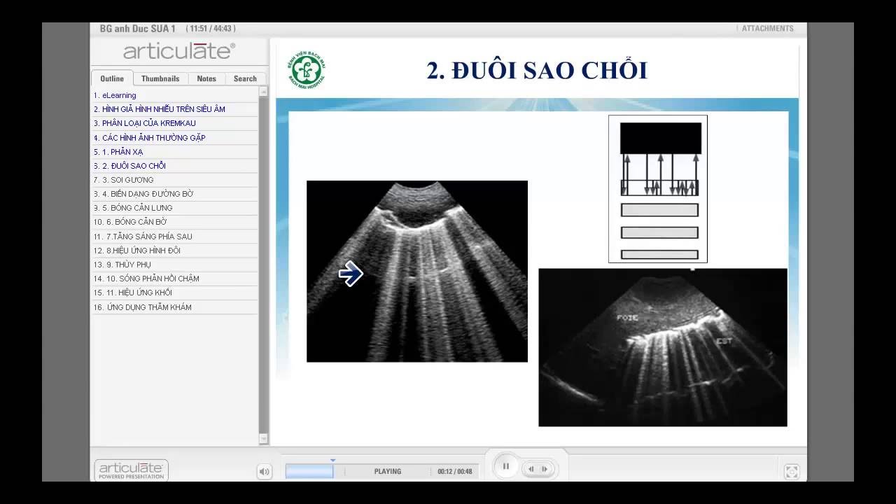 Hình ảnh nhiễu trên siêu âm (Bv Bạch Mai)
