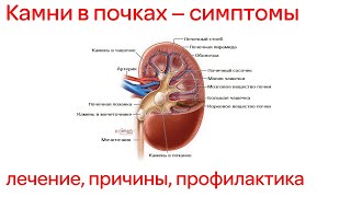 Камни в почках – симптомы у женщин и мужчин, лечение, причины, профилактика и прогноз