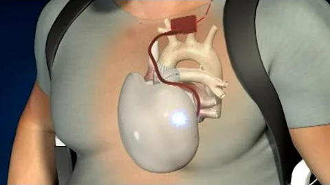Cœur artificiel: un troisième patient greffé