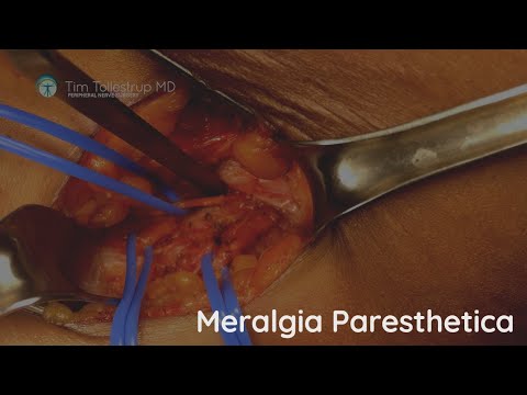 Videó: Meralgia Paresthetica Gyakorlatok: Lépésről Lépésre útmutató A Fájdalomcsillapításra