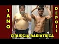 Cirurgia bariatrica  evoluo 1 ano depois 2018