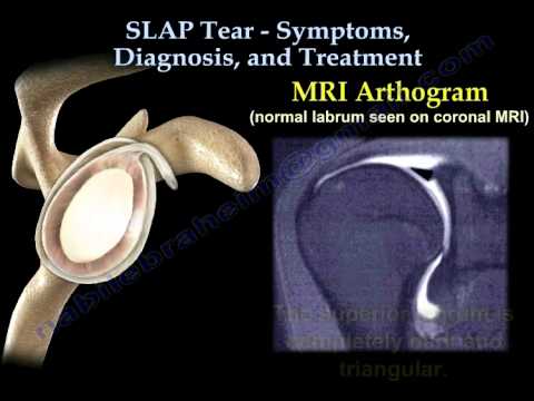 Video: SLAP Tear: Oorzaken, Symptomen, Diagnose, Behandeling En Vooruitzichten