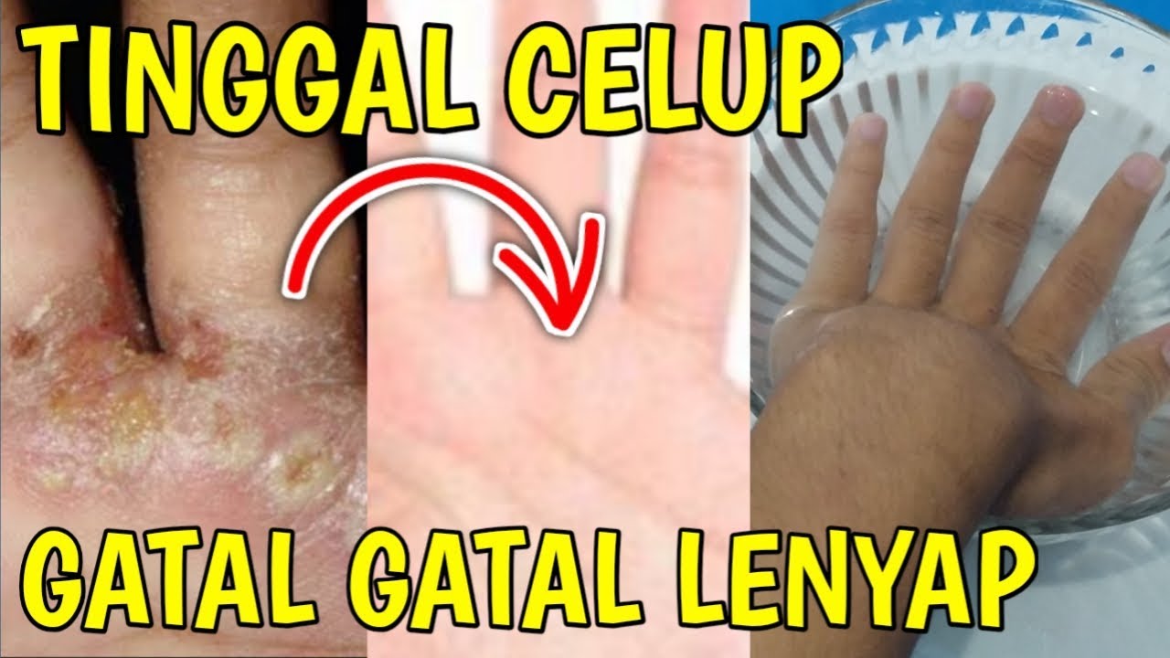 CARA MENGOBATI KULIT GATAL, GUDIK, KURAP, KUTU AIR PALING MANJUR DI