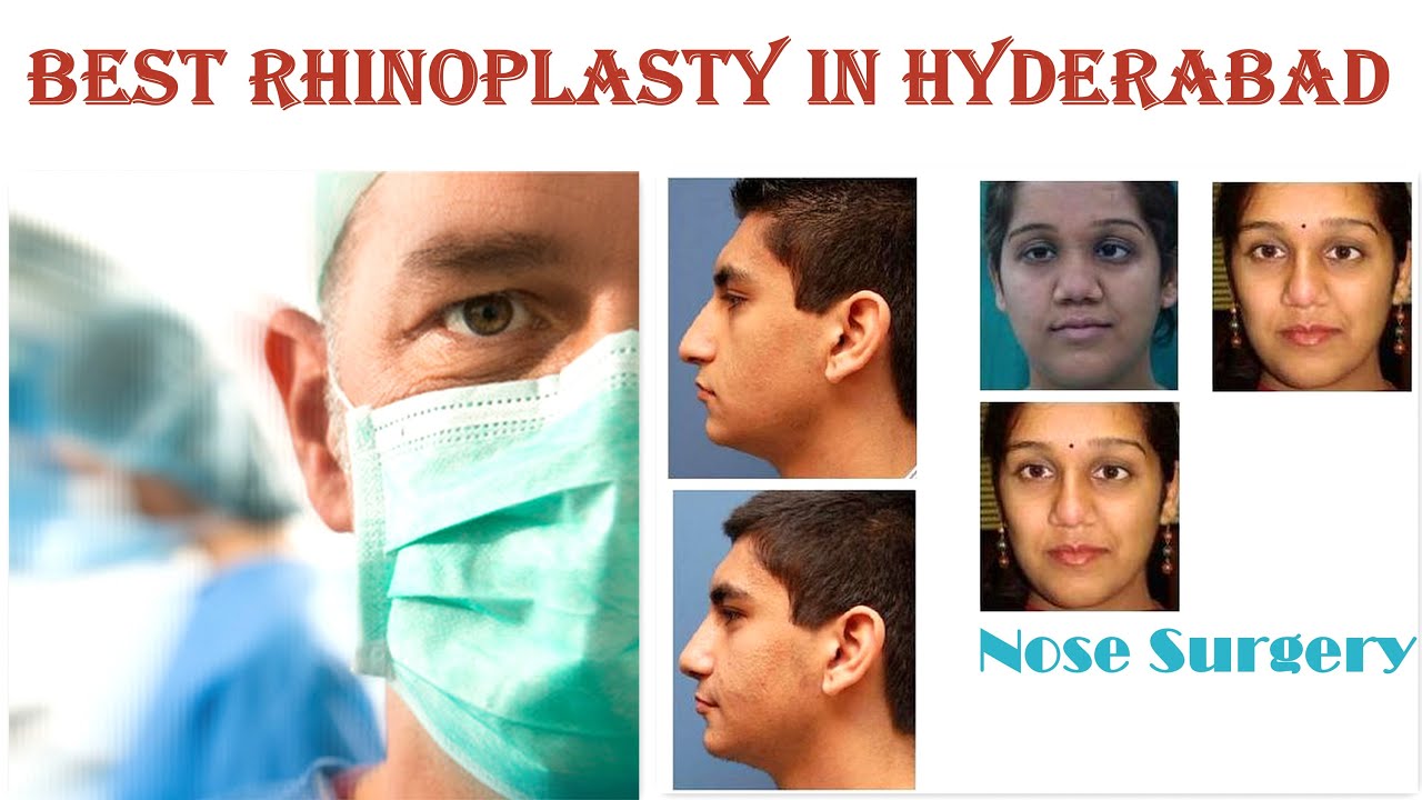 Rhinoplasty in Hyderabad Best Rhinoplasty in Hyderabad Nose Job Cost in Hyderabad YouTube