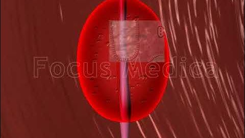 Pathological features - Animated Atlas of BPH and OAB