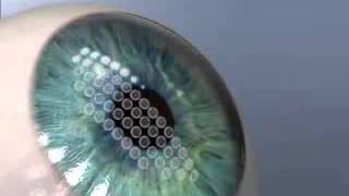 Intralaser Laser Technology
