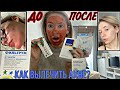 АКНЕ / ЛУЧШИЕ ВИТАМИНЫ / ИСТОРИИ ИЗ ЖИЗНИ