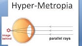 mi a myopia és a hyperopia