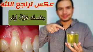 سر تراجع اللثه الذي لا يخبرك به أحد كيف تعكس تراجع اللثه بنفسك