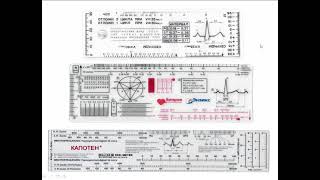 4 способа расчета ЧСС на ЭКГ