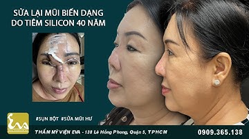 Giải cứu chiếc mũi biến dạng do bơm Silicon cách đây 40 năm