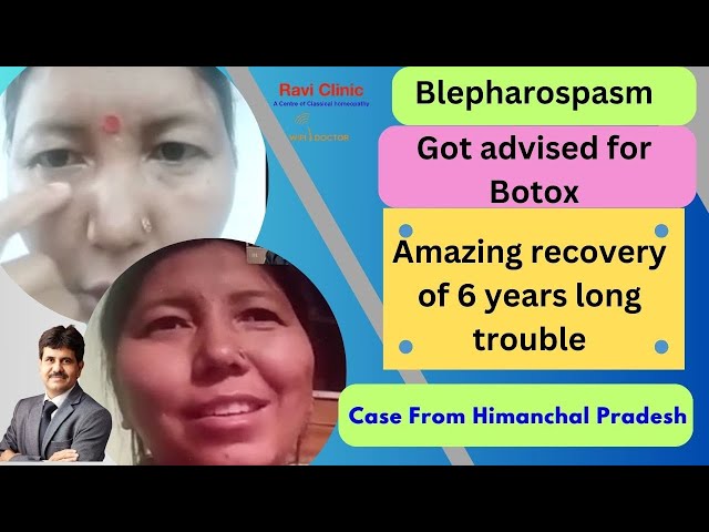 Blepharospasm for years got cured in patient from Himanchal Pradesh   Dr Ravi Singh