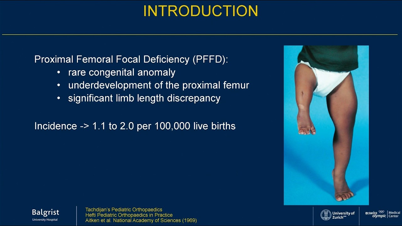 Balgrist erklärt: Proximal Focal Femoral Deficiency (PFFD) - YouTube