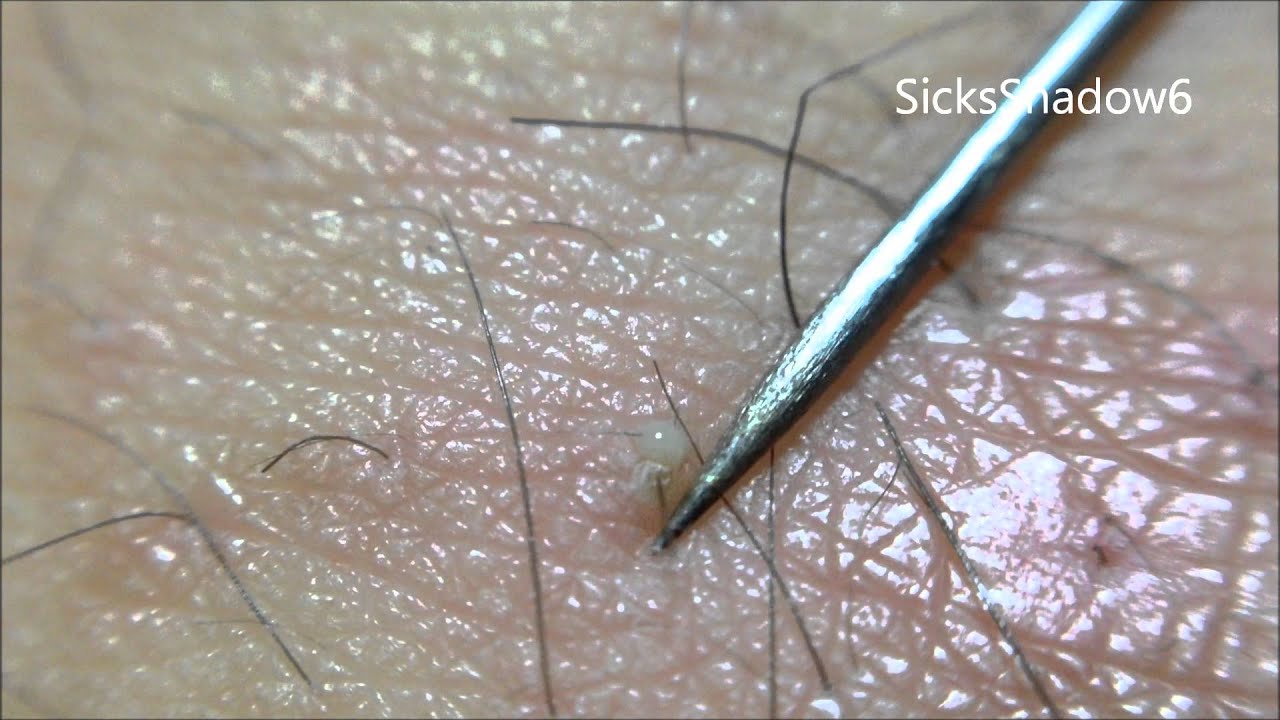 毛穴ニキビを針でえぐる Youtube