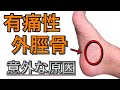 【有痛性外脛骨】「なんか足が痛い…」運動中の痛みが気になる人に　【原因　改善方法】