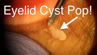 Cyst of Zeiss Eyelid Cut Out - DEEP