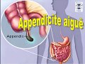 Appendicite aiguë symptome douleur examen clinique cours médecine