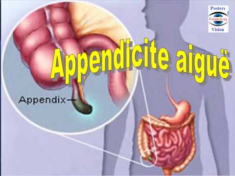 Vidéo: Appendicite Catarrhale