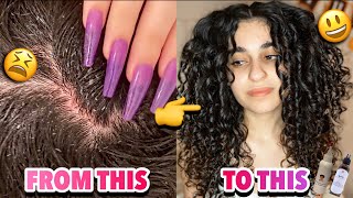 HOW TO HEAL, TREAT, &amp; DEAL WITH DRY, ITCHY, FLAKY, &amp; IRRITATED SCALP! || Curly Hair Scalp Health