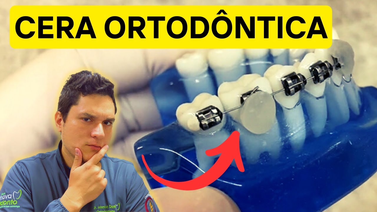 Cera Per Apparecchio Denti: Come Si Usa - Dentista Sanitas - Foto 2