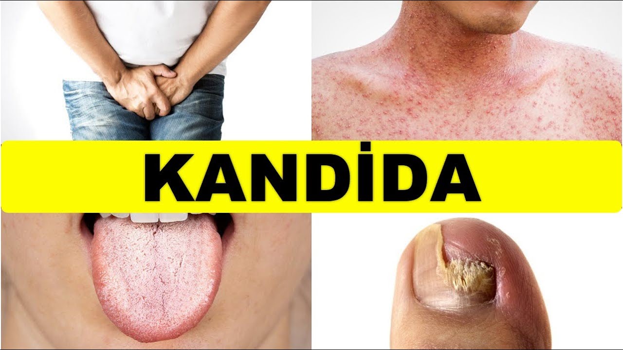 Kandidayı Geri Dönmemek Üzere Tedavi Etmenin Tek Yolu - Dr. Berg Türkçe