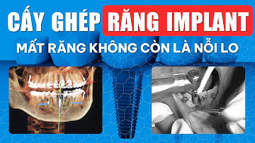 Cấy Ghép Răng Implant - Mất Răng Không Còn Là Nỗi Lo | Nam Bùi Vinalign