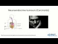 Oxford University surgical lectures: Small intestinal neuroendocrine tumours