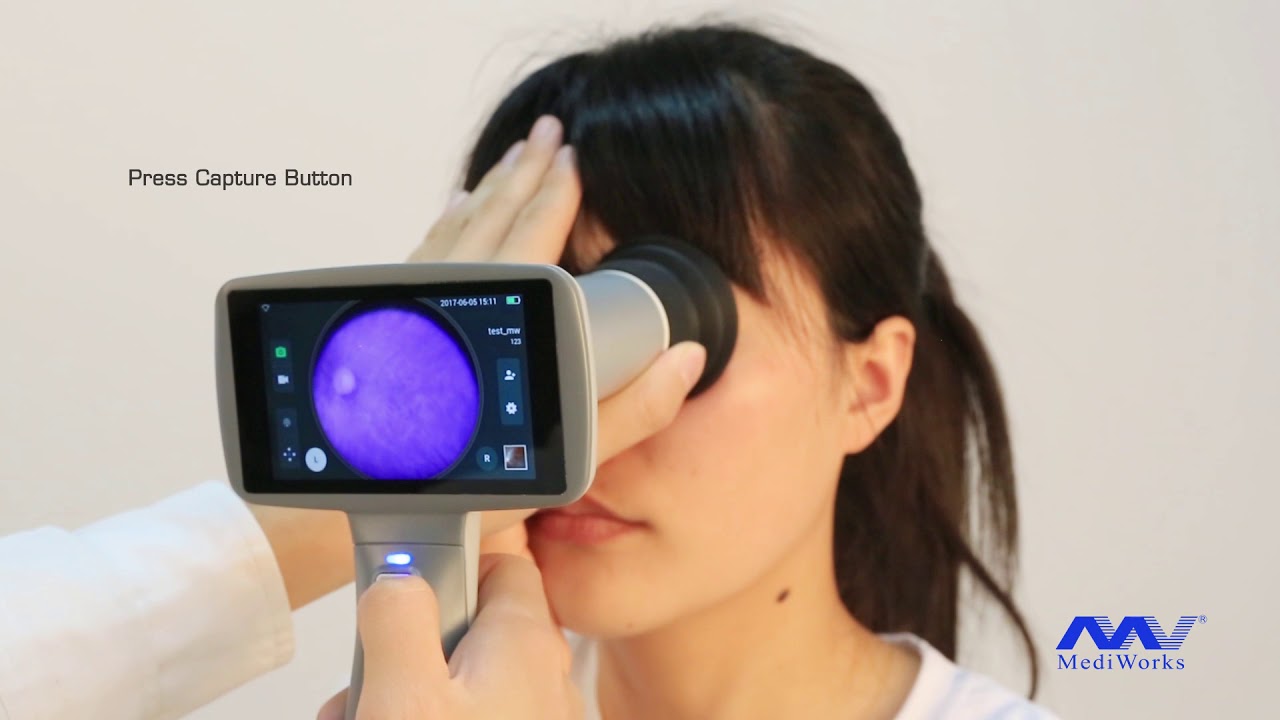 Dragonfly Hand held Fundus Camera 20170622