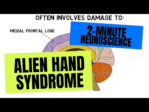 2-Minute Neuroscience: Alien Hand Syndrome