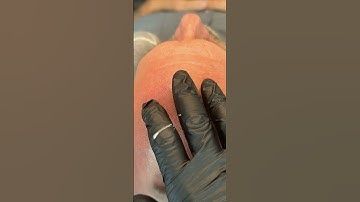 Embracing Beginnings: A Journey from Extreme Hair Loss to Confidence through Scalp Micropigmentation