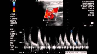 Duplex Exam of Moderate ICA Stenosis - Case Study