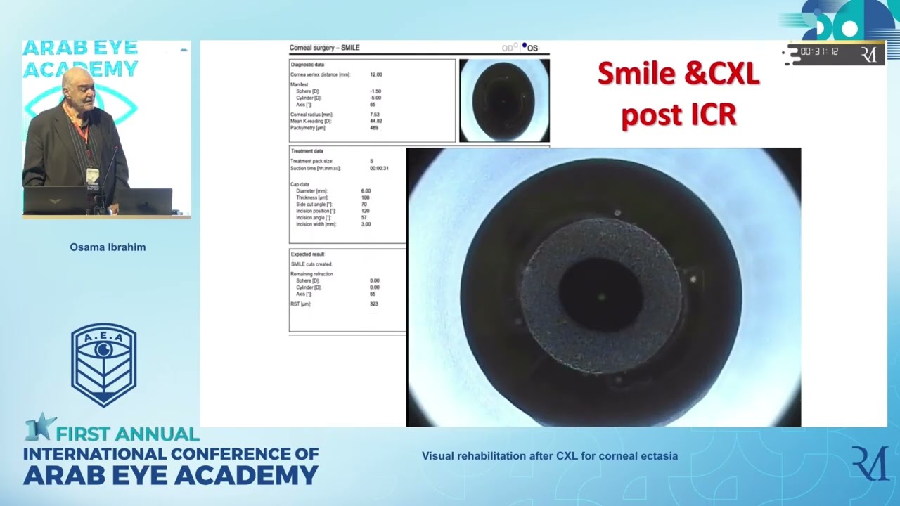Visual rehabilitation after CXL for corneal ectasia