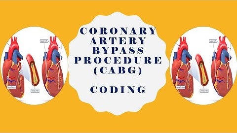 CARDIOVASCULAR SYSTEM CODING |CORONARY ARTERY BYPASS PROCEDURE (CABG) | MEDICLUX CODING TRAINING |