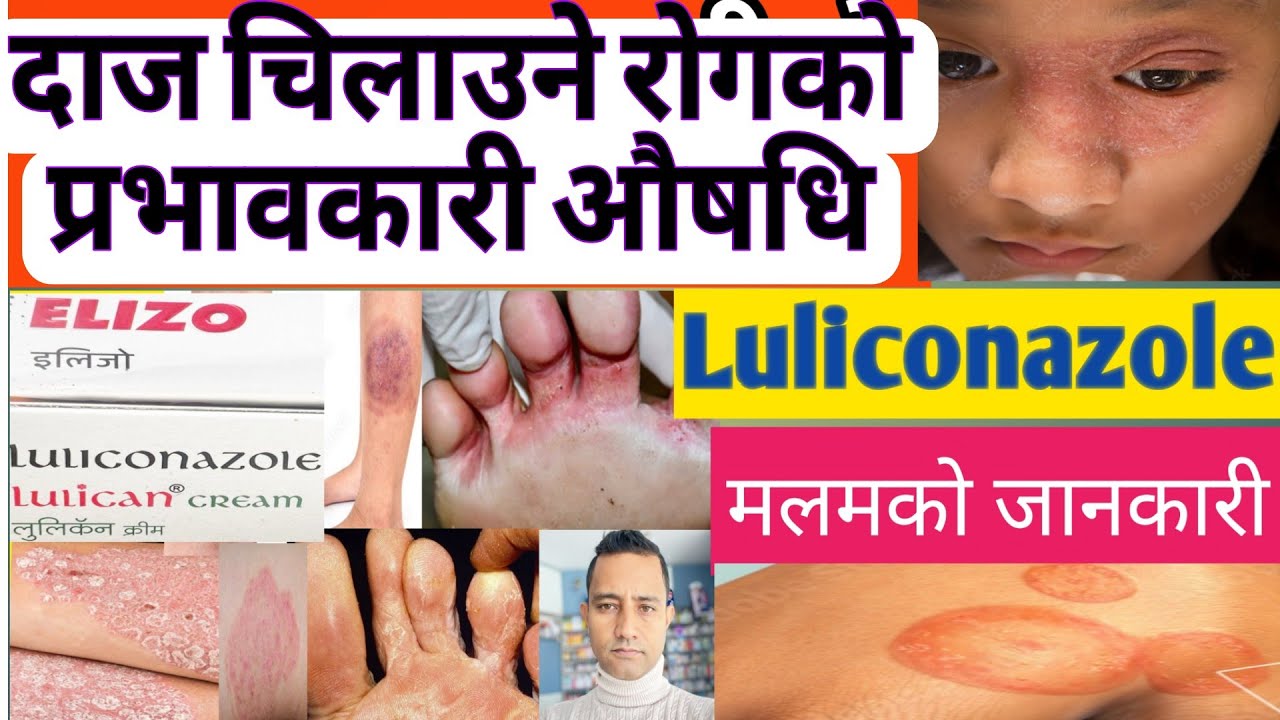 Luliconazole cream details in Nepali.दाजको प्रभावकारी औषधि। Ringworm